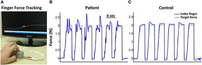 <mark class="highlighted">Manual Dexterity</mark> in Schizophrenia—A Neglected Clinical Marker?